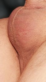 An image of scrotal raphe and perineal raphe.jpg